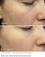 Active Peel System