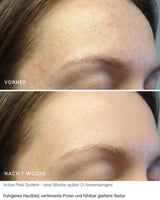 Active Peel System