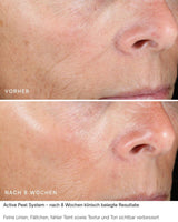 Active Peel System