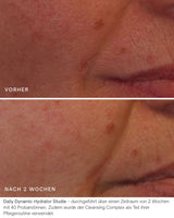 Vorher Nachher Daily Dynamic Hydrator Studie