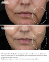 Vol.U.Lift von IMAGE Skincare - glp-1 4D skin rebound complex vorher nachher klinische ergebnisse