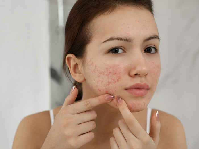 Welk soort acne heeft u? Zo herkent u de verschillen en vindt u de juiste behandeling!