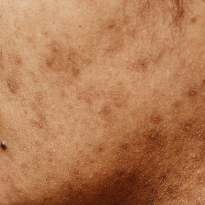 Hyperpigmentierung & Pickelmale: Welche Wirkstoffe und Behandlungen helfen wirklich?